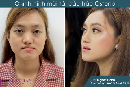 Người sứt môi hở hàm ếch sẽ có cơ hội được phẫu thuật miễn phí